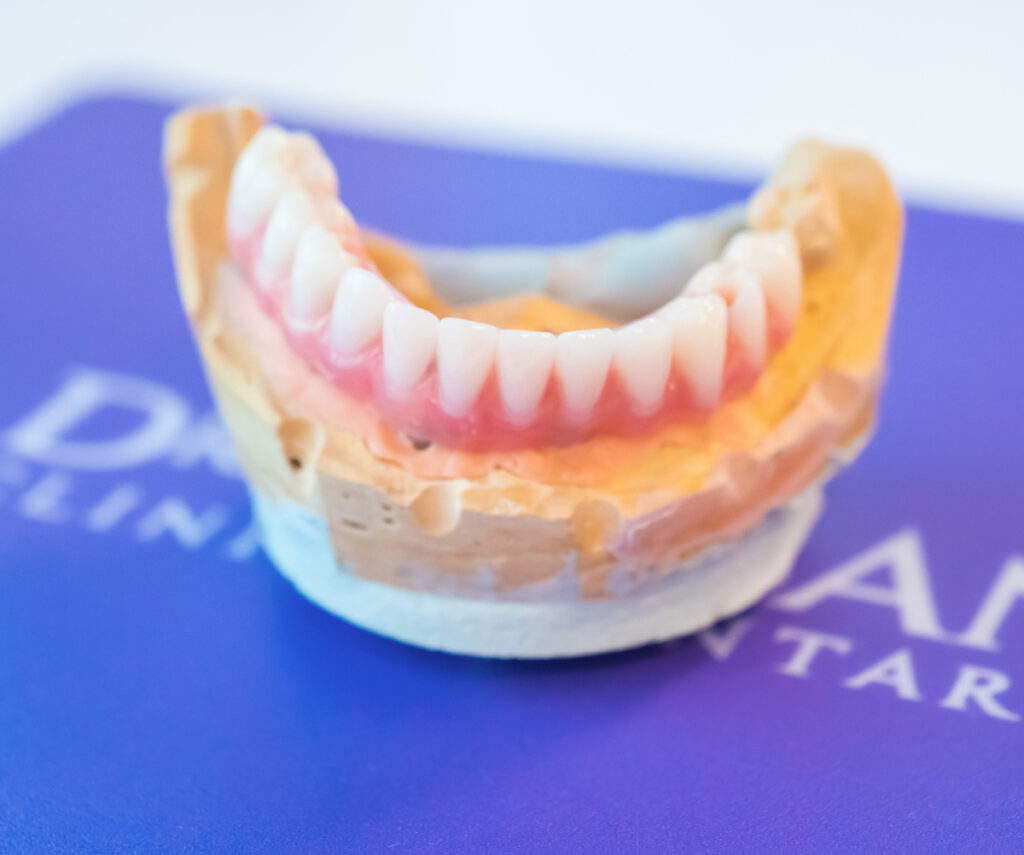 Coroanele dentare: când și de ce ai nevoie de ele?