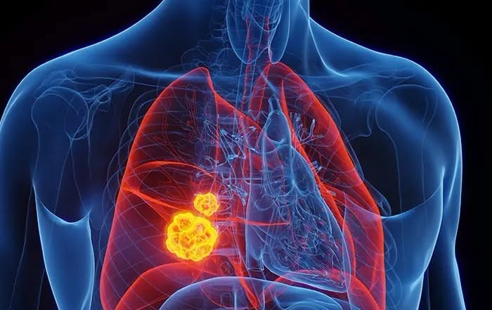 Semnal de alarma de Ziua Mondiala de Lupta Impotriva Cancerului Pulmonar